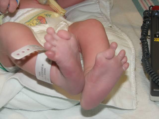 Imagem de um bebê com o dedão do pé malformado, sintoma da FOP